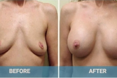 breast-implant-before-after