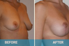 breast-lift-surgery-gold-coast