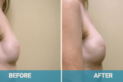 breast-reconstructoin-surgery-aus
