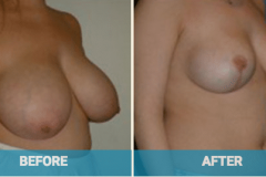breast-reduction-surgery-gold-coast