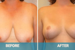 reduction-before-and-after
