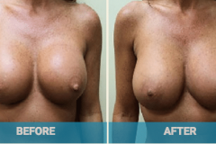breast-nipple-revision