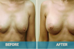 breast-revision-gold-coast