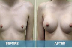 augmentation-surgery-front