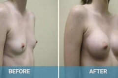 breast-implants-gold-coast