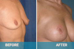breast-lift-prices-gold-coast