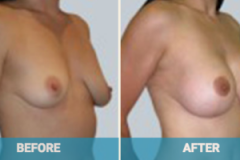 gold-coast-breast-lift-300x200