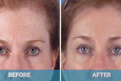 brow-lift-before-and-after