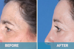 brow-lift-gold-coast-before-and-after