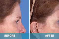 brow-shaping-cosmetic-procedure