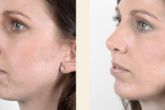 chin-surgery-before-and-after