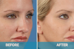before-and-after-dermal-fillers