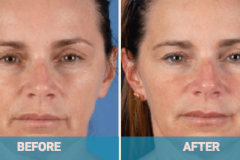 dermal-fillers-before-and-after