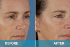 dermal-fillers-gold-coast