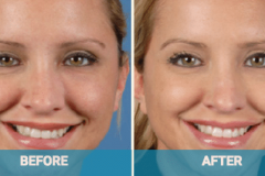 gold-coast-dermal-fillers-cost