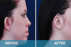 ear-shaping-plastic-surgery-gold-coast