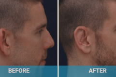 ear-surgery-before-and-after