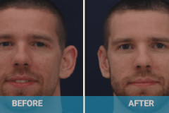 ear-surgery-cost-gold-coast