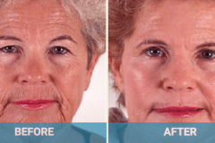 eyelid-surgery-cost-gold-coast