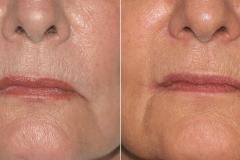 corner-lip-surgery