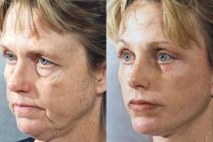face-lift-procedure-before-and-after