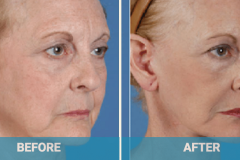 face-lift-procedure-cost-gold-coast