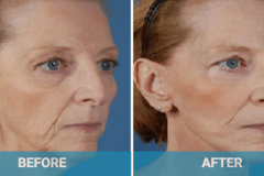 face-lift-procedure