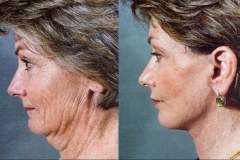 neck-face-lift-surgery