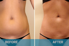 liposuction-before-and-after