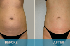 liposuction-procedure-gold-coast-before-and-after
