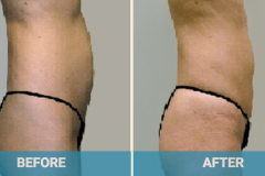 liposuction-procedure-gold-coast