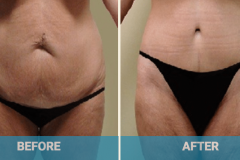 lower-body-lift-before-and-after