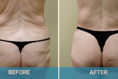 lower-body-lift-procedure