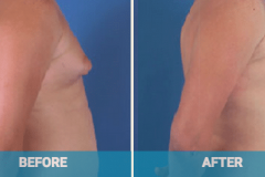 male-breast-reduction-gold-coast