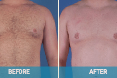 male-reduction-before-and-after