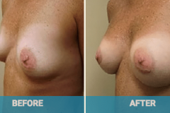 mommy-makeover-bef-re-and-after