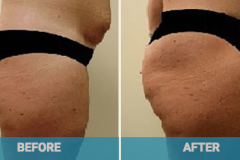 mummy-makeover-gold-coast-butt