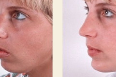 chin-surgery-gold-coast-cost