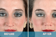 nose-reconstruction-surgery-gold-coast
