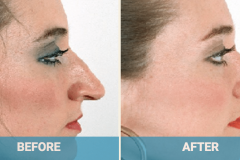 rhinoplasty-before-and-after