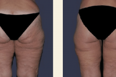 thigh-lift-gold-coast-before-and-after