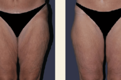 thigh-lift-gold-coast-cost