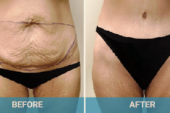 tummy-tuck-before-and-after