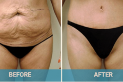 tummy-tuck-gold-coast-cost