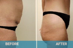 tummy-tuck-gold-coast