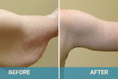 arm-lift-cost-gold-coast