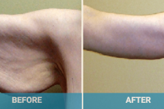 arm-lift-procedure-gold-coast